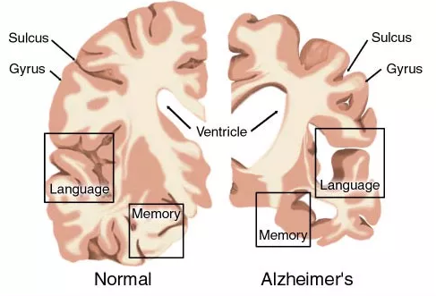 AD药物研发明状：：辉瑞、礼来、百健、诺华、强生……