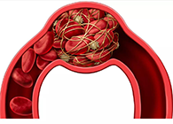 令人“闻风丧胆”的脑卒中发明治疗新机制！！