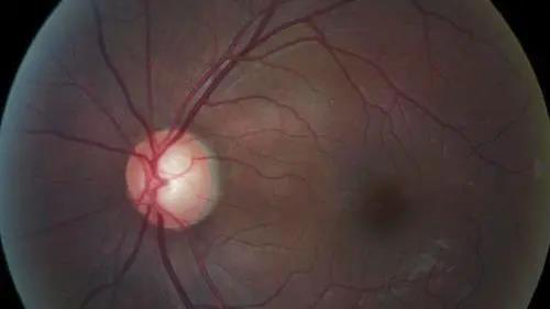 青光眼的克星来袭，，，助力患者远离视力的“窃贼”