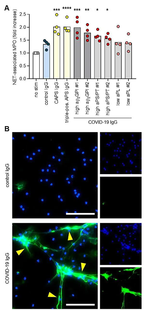 COVID-19患者IgG在体外增进从正常嗜中性粒细胞释放NET