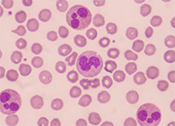 一种神秘颗粒被发明了！！！它能否成为败血症早筛标记物？？？